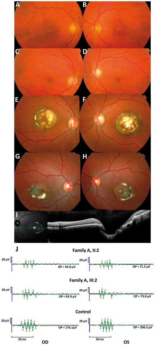 Family A. Fundus photographs of the mother (A-B, I: 2) and the brother (C-D, II: 3) of the index (II: 2). The index (E-F) and her daughter (G-H) have a Grade 3 and a visual acuity of 20/40 in the right eye, 20/60 in the left eye and 20/40 in the right eye and 20/25 in the left eye respectively. For these two last patients, note the severe macular disorganization with atrophy, retinal pigment epithelium tufts, fibrosis and with a profound excavation or ‘caldera’ on OCT frame (I). OPs in two affected subjects and in one control (J): Note the reduction of the late Ops suggesting a dysfunction of rod associated amacrine cells. All latencies are increased.