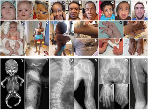 Clinical spectrum of the B3GALT6 spondylodysplastic type of the EDS. Clinical pictures and radiographs of PI:1 at age 4 years and 11 months (A, O), PII:1 at age 10 years (B, J) and 7 months (T), PIII:1 at age 8 months (C), PIV:1 at age 26 (D, Q) and age 24 (U, W, Y, Z) years, PIV:2 at age 28 years (E, M, N), PIV:3 at age 30 (F, K, L, R) and age 28 (V) years, PV:1 at age 7 years (G, X), PVI:1 at birth (P), PVII:1 at age 5 years (H), PVIII:1 at age 5 years (I), and PIX:2 (S) at 22 weeks of gestation.