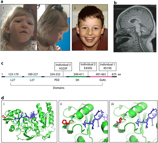 Patient clinical phenotypes and variant localization. (A) Images of dysmorphic features seen in Individual 1 (i) and Individual 2 (ii). (B) Brain MRI image of Individual 1, highlighting the mild decrease in gyral folding. (C) MPP5 gene with domains and patient variants noted. (D) Molecular modeling of the missense variant in individual 3 with (i) showing the overall protein structure of MPP5, (ii) depicting His325 and (iii) showing Pro325.