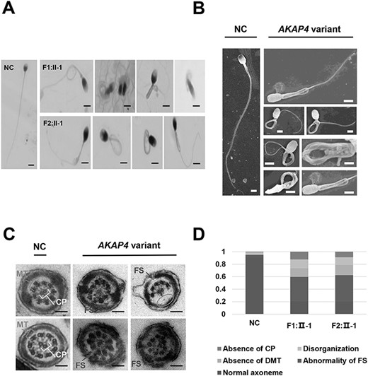 Anomalous sperm flagellar development of MMAF-affected patients carried AKAP4 variant. NC: normal control. AKAP4 variant: men harboring hemizygous AKAP4 variant. F1–F2 represent family 1–2. II-1 represent the patient number. (A) H&E staining of spermatozoa from patients and NC (scale bars, 20 μm). (B) SEM analysis of the spermatozoa from NC and men harboring hemizygous AKAP4 variant (scale bars, 20 μm). (C) The ultrastructure analysis of the sperm flagella from NC and men harboring hemizygous AKAP4 variant using transmission electron microscope (TEM) (scale bars, 200 nm). (D) The proportion distribution of ultrastructural abnormalities of the sperm flagella (1 represents 100%).
