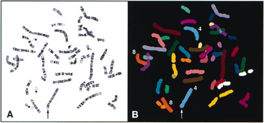 SKY analysis of a patient with Wolf-Hirschhorn syndrome. (A) G-banded metaphase. The telomeric region of one chromosome 4 (arrow) shows a slightly abnormal banding pattern. (B) The same metaphase as shown in (A) after SKY analysis. Chromosome classification revealed an unbalanced translocation between chromosomes 4 and 8 [46,XY,der(4)t(4,8)].