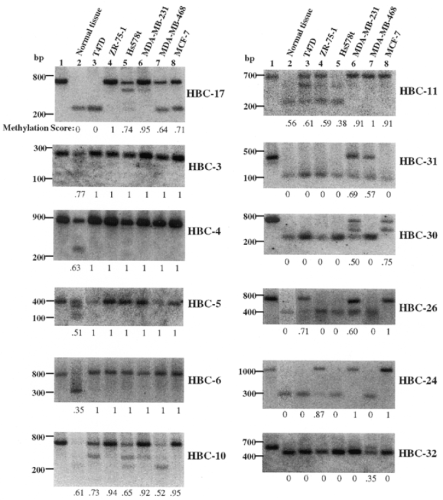 Representative results of methylation analysis by Southern hybridization. Genomic DNA (10 µg) from a normal breast tissue sample (lane 2) and breast cancer cell lines, T47D (lane 3), ZR-75–1 (lane 4), Hs578t (lane 5), MDA-MB-231 (lane 6), MDA-MB-468 (lane 7) and MCF-7 (lane 8), was treated consecutively with MseI and methylation-sensitive BstUI, and subjected to Southern hybridization. Lane 1, control DNA digested with Mse I only. The digests were hybridized with genomic fragments (200–300 bp) derived from CpG island clones shown on the right. Molecular weight markers (100 bp ladder; Promega) are shown on the left. The percentage methylation was calculated as the intensity of the methylation band relative to the combined intensities of all bands. The percentage of incomplete methylation was calculated similarly. The methylation score shown at the bottom of each lane was the sum total of the percentage of complete methylation multiplied by 1 plus the percentage of incomplete methylation multiplied by 0.5 (see detailed description in the text).