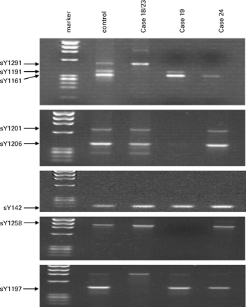 A 2% agarose gel showing the presence or absence of specific primers in the cases with novel partial AZFc microdeletions: cases 18 and 23 (sY1191, sY1161 and sY1197 absent), case 19 (sY1291, sY1201, sY1206 and sY1258 absent) and case 24 (sY1291 and sY1191 absent).