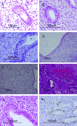 Histological sections stained with haematoxylin and eosin (A–G) and the immunohistochemical stain Ki-67 (H). (A) Pretransplantation endometrial tissue: the proliferative phase. The glands are small straight and narrow, with columnar glandular cells and prominent pseudostratification of the nuclei. The stromal cells are dense (magnification ×400). (B) Endometrial tissue 14 days after transplantation: E2 has been administered for 14 days. The glands are small and narrow, with tall columnar cells. Evidence of pseudostratification of the nuclei is present. The stromal cells are dense (magnification ×400). (C) Endometrial tissue 16 days after transplantation: E2 has been administered for 14 days, followed by E2 plus progesterone for 2 days. The glands still show pseudostratified structures but they have begun to enlarge, and subnuclear vacuolation of the glandular cells is visible. The stromal cells remain dense (magnification ×400). (D) Endometrial tissue 21 days after transplantation: E2 has been administered for 14 days, followed by E2 plus progesterone for 7 days. The glands are significantly dilated, the glandular cells are cuboidal and the pseudostratification of the nuclei has disappeared. Stromal decidualization is beginning. Many lymphocytes are present throughout the stroma and are aggregating around the glands (magnification ×200). (E) Endometrial tissue 28 days after transplantation: E2 has been administered for 14 days, followed by E2 plus progesterone for 14 days. The glandular cells are cuboidal. Evidence of stromal decidualization is clearly seen and lymphocytes are present in the stroma (magnification ×200). (F) Endometrial tissue 31 days after transplantation: E2 had been administered for 14 days, followed by E2 plus progesterone for 14 days, and then no hormones for the remaining 3 days. The glands and endometrial stroma have collapsed during the evolution of the transplant. There is prominent bleeding in the stroma (magnification ×200). (G) Endometrial tissue 35 days after transplantation: E2 had been administered for 14 days, followed by E2 plus progesterone for 14 days, and then no hormones for the remaining 7 days. The glands are small and narrow with tall columnar cells. Evidence of pseudostratification of the nuclei is present. The stromal cells are dense (magnification ×400). (H) Endometrial tissue 35 days after transplantation: a number of nuclei have been immunohistochemically stained with Ki-67, showing proliferation of glandular and stromal cells (magnification ×400).