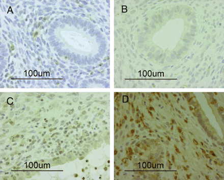 Immunohistochemical staining of human CD56. (A) Pretransplantation endometrial tissue: human CD56-positive cells are present in small numbers (magnification ×400). (B) Day 14 after transplantation: human CD56-positive cells have completely disappeared from the stroma (magnification ×400). (C) Day 21 after transplantation: human CD56-positive cells are present in small numbers (magnification×400). (D) Day 28 after transplantation: human CD56-positive cells have significantly increased in number in the stroma (magnification ×400).
