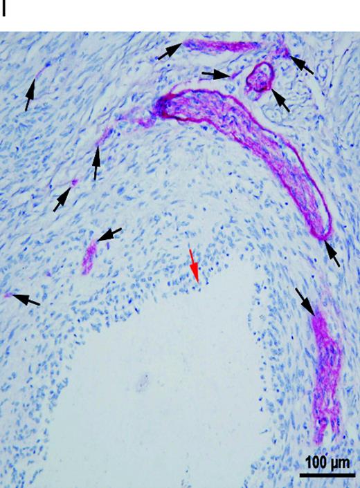 Nerve fibres in peritoneal endometriotic lesions and a peritoneal endosalpingiosis lesion. (A) Peritoneal endometriotic lesion stained with protein gene product 9.5 (PGP9.5) and permanent fast red chromogen (magnification ×200). Arrows denote PGP9.5-positive nerve fibres near an endometriotic gland. (B) Peritoneal endosalpingiosis lesion stained with PGP9.5 and permanent fast red chromogen (magnification ×200). Arrows denote tiny PGP9.5-positive nerve fibres. (C) Peritoneal endometriotic lesion stained with neurofilament (NF) and permanent fast red chromogen (magnification ×200). Arrows denote NF-positive myelinated nerve fibres near an endometriotic gland. (D) Peritoneal endometriotic lesion stained with substance P (SP) and 3,3′-diaminobenzidine (DAB) (magnification ×400). Arrows denote tiny SP-positive nerve fibres near an endometriotic gland. (E) Peritoneal endometriotic lesion stained with calcitonin gene-related peptide (CGRP) and DAB (magnification ×200). Arrows denote CGRP-positive nerve fibres near an endometriotic gland. (F) Peritoneal endometriotic lesion stained with acetylcholine (ACh) and DAB (magnification ×200). Arrow denotes ACh-positive nerve fibres near an endometriotic gland. (G) Peritoneal endometriotic lesion stained with tyrosine hydrolase (TH) and DAB (magnification ×400). Arrows denote TH-positive nerve fibres near an endometriotic gland. (H) Peritoneal endometriotic lesion stained with nerve growth factor (NGF) and DAB (magnification ×200). (I) Peritoneal endometriotic lesion stained with nerve growth factor receptor p75 (NGFRp75) and permanent fast red chromogen (magnification ×200). Black arrows denote NGFRp75-positive nerve fibres and nerve fibre trunks near an endometriotic gland (red arrow). Magnification ×400 was used due to small size of nerve fibres. Scale bars represent 50 µm in D, G and H; and 100 µm in A–C, E, F and I.