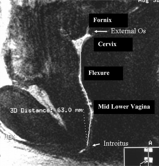This figure represents a sagittal image of the human vagina. For illustration purposes this is an image that contains gel mixed with gadolinium contrast (white) to demarcate the vaginal canal. The outline of the vagina can be seen from the cervix and linearly to the introitus. The length of the ‘curved’ line in the vertical plane is the linear length of the vagina. In this case, the measurement was 63 mm.