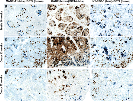 Identification of subpopulations of fetal germ cells by double immunostaining of OCT4 and MAGE-A1, GAGE or NY-ESO-1. The GAGE-positive cell population partially overlapped the population of OCT4-positive cells, allowing the identification of three subpopulations of germ cells: OCT4pos/GAGEpos, OCT4neg/GAGEpos and OCT4pos/GAGEneg (b, e and h). In contrast, dual staining combining OCT4- and MAGE-A1- or NY-ESO-1-reactivity clearly showed that OCT4 and MAGE-A1 or NY-ESO-1 were not co-expressed (a, c, d, f, g and i). No staining was observed using the negative control antibody (Magnification: × 10).