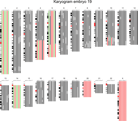 The karyogram of embryo 19 is shown. The karyogram is composed of color bars that each represent the chromosome copy number state based on the results of the BAC (bacterial artificial chromosomes) array and the SNP (single nucleotide polymorphism) copy number and genotyping data in a specific blastomere. Black represents a normal region, red a hemizygous deletion, green a duplication, dark green an amplification and gray discordance between the analyses or unreliable aberrations. In this male embryo, whole chromosome imbalances of mitotic origin were detected in chromosomes 1 and 14, whereas chromosome 20 showed a monosomy in all sister blastomeres suggesting a meiotic non-disjunction. Moreover, 4q and 10q terminal deletions with a reciprocal 4q duplication and 10q amplification respectively were detected in a proportion of its sister blastomeres. Finally, a 5q terminal deletion and reciprocal 5q duplication were detected in two blastomeres, whereas the remaining part of the chromosome proximal to the 5q deletion was trisomic. Two sister blastomeres contained a monosomy for chromosome 5. In addition, a remaining sister blastomere contained three copies of chromosome 5, whereas a fifth lacked a 5q terminal part of which the size was equal to the partial deletion and duplication in its sister blastomeres.
