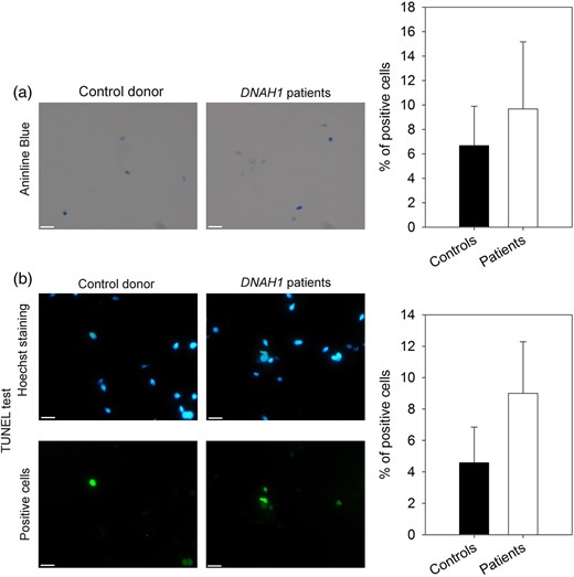 Measure of DNA condensation and fragmentation. (a) DNA condensation was measured from sperm cells stained with aniline blue (AB). Control sperm (left) were not significantly different (the student t-test, P = 0.45) from patients' sperm (right). The histogram shows the percentage of sperm cells stained for fertile controls (n = 6) and patients (n = 3). Bars represent mean + standard deviation (SD). (b) DNA fragmentation analysis with terminal deoxynucleotidyltransferase-mediated dUTP nick-end labeling (TUNEL test) assay. Hoechst and TUNEL staining for control sperm (left) were not significantly different (the student t-test, P = 0.12) from staining for patients' sperm (right). The histogram shows the percentage of TUNEL positive cells for fertile controls (n = 6) and patients (n = 3). Bars represent mean + SD.