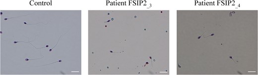 Morphology of spermatozoa from two patients with a mutation in the FSIP2 gene. All spermatozoa from patients FSIP2_3 and FSIP2_4 have shorter flagella than controls with no mutation in the fibrous sheath interacting protein 2 (FSIP2) gene. Additional features of spermatozoa from men with the multiple morphological abnormalities of the sperm flagella (MMAF) phenotype, such as thick and coiled flagella, are also observed. Scale bars 10 μm.