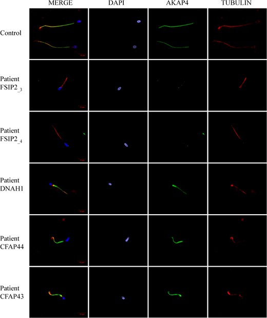 A-kinase anchoring protein 4 is absent in sperm cells from patients with FSIP2 mutations. Sperm cells from a fertile control, the two patients FSIP2_3 and FSIP2_4, and three other patients mutated in dynein axonemal heavy chain 1 (DNAH1) gene, and in the cilia and flagella associated protein 43 (CFAP43) and 44 (CFAP44) genes, respectively, were stained with anti-A-kinase anchoring protein 4 (AKAP4: green) and anti-acetylated tubulin (red) antibodies. DNA was counterstained with DAPI showing sperm nuclear DNA (blue). The AKAP4 immunostaining is concentrated in the PP of the spermatozoa from the fertile control and the three patients mutated in DNAH1, CFAP43 and CFAP44. Conversely, AKAP4 staining is absent in sperm from the two patients FSIP2_3 and FSIP2_4. Scale bar 10 μm.