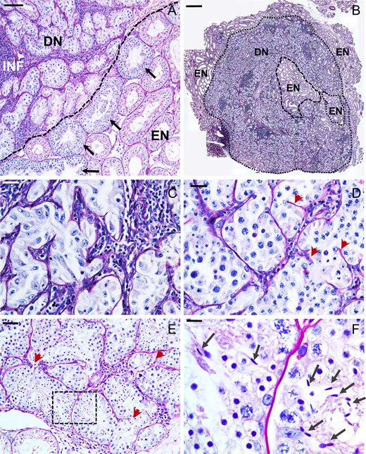 Histology of the abnormal tubules observed in the transplanted monkey (Macaca mulatta) testis. (A) Section of transplanted testis showing disorganized and misshapen tubules, likely derived de novo (DN) from the transplanted testicular cells. These tubules are interspersed with inflammatory (INF) cells. There generally was a clear boundary (dashed line) between the area packed with these abnormal tubules and the endogenous (EN) tubules. The endogenous tubules at this boundary were enriched with repopulated tubules (arrows). (B) The de novo tubules invaded a major area in this section near the pole of the testis. De novo tubules were either Sertoli cell-only (C) or contained stages until spermatocytes (D), round spermatids (E) or mature spermatids (arrows in F, which is enlarged from boxed portion in E). Note the incomplete basal laminae within the tubules (red arrowheads). Scale bars: A: 50 μm, B: 1 mm, C,D,E: 25 μm and F: 10 μm.
