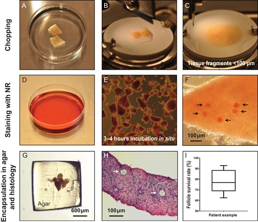 Practical steps. (A) Two pieces of thawed human ovarian tissue. (B) Ovarian tissue pieces placed on the cutting board in the McIIwain Tissue Chopper adjusted to 0.1 mm. (C) Tissue pieces were cut into smaller fragments <100 μm by repeated chopping (10–12 times). (D) Culture dish containing culture medium with 50 μg/ml NR solution (15 μl of NR per 1 ml of culture media). (E) Ovarian tissue fragments were incubated in NR containing culture media for 3–4 h in situ. (F) Selected tissue fragments were evaluated for the presence of NR-stained follicles and the exact number was recorded. Arrows point to NR-stained follicles within the tissue fragment. (G) Tissue fragments were encapsulated in a 4% w/v agar gel. (H) The total number of follicles in each tissue fragment was recorded during histological evaluation. Arrows point to follicles within the tissue fragment. (I) Box-plot (median, quartiles,range) depicts the follicle survival rate for Patient 16, and the exact follicle numbers and survival rates are presented in Supplementary Table SI. NR, Neutral Red.