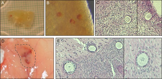 Validating follicle survival in cryopreserved ovarian tissue from a Polish patient by NR staining and xenografting. (A) A piece of frozen/thawed ovarian tissue. (B) NR-stained follicles within the tissue. (C) Histological evaluation of tissue fragments with NR-stained follicles. (D) Following 4 weeks xenografting, revascularization was observed in the graft. (E) Histological evaluation of the xenografted tissue. NR, Neutral Red.