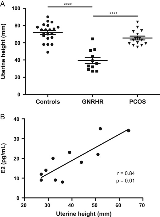 Uterine height in women in the study. A: Comparison of uterine height (UH) between 23 nulliparous healthy women in the early follicular phase (controls) in 11 normosmic congenital hypogonadotrophic hypogonadism (nCHH) patients carrying biallelic GNRHR mutations, and in 15 teenagers with polycystic ovary syndrome (PCOS) or young women in which the condition was revealed by primary amenorrhea or primary/secondary amenorrhea; UH was measured at diagnosis before any hormonal therapy; Horizontal line shows the mean ± SD error bars. B: correlation between UH and circulating estradiol (E2) levels in untreated nCHH patients carrying biallelic GNRHR mutations at diagnosis. All data are individual values. ***P < 0.001. Spearman’s rank correlation.