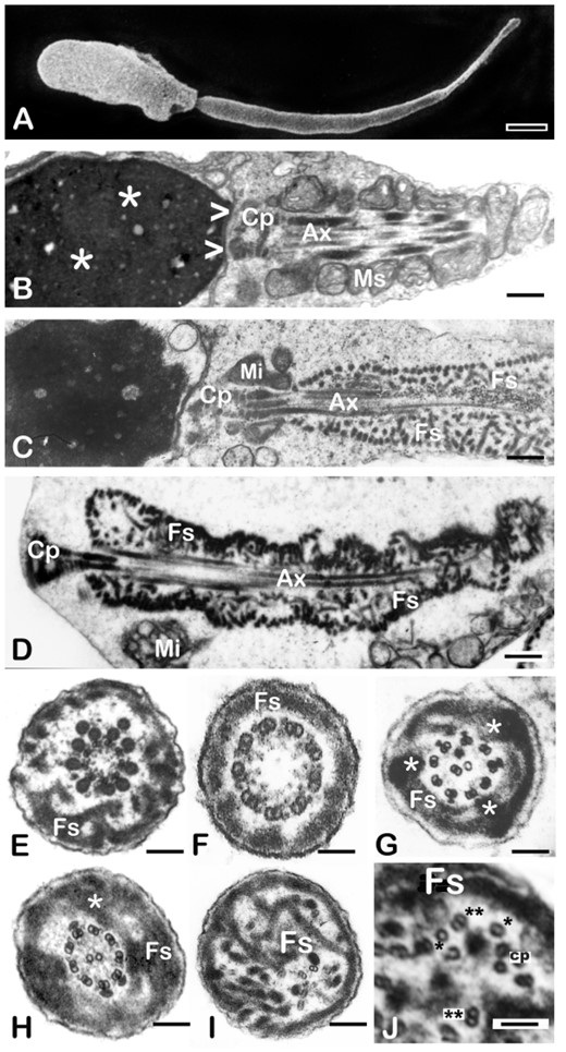 Characterisation of the DFS-MMAF phenotype by scanning and transmission electron microscopy. (A) Scanning EM of a typical DFS-MMAF spermatozoon (ARG1). The head is abnormally shaped and the mid piece is absent. The sperm tail is very short and thick (7.7 µm long and 630 nm in diameter (normal values of 50 µm in length and 100–140 nm in diameter). (B) Longitudinal section of the head, connecting piece and mid piece of a normal human spermatozoon. The sperm head shows densely condensed chromatin (asterisks). At its caudal pole there is a shallow concavity (the implantation fossa, arrowheads) where the connecting piece (CP) and centrioles of the sperm tail are lodged. A helically arranged mitochondrial sheath (MS) surrounds the first part of the axoneme (Ax) with its central microtubules and peripheral outer dense fibers (see mid piece cross section in Fig. 1). (C) Longitudinal section of a typical DFS-MMAF spermatozoon to illustrate the details of the phenotype (patient not included in the genetics part of this study). A largely missing mitochondrial sheath is replaced by few mitochondria (Mi). The axoneme (Ax) and outer dense fibers are surrounded by a thick, multilayered, haphazardly arranged fibrous sheath (FS). (D) Longitudinal section of a DFS-MMAF/acephalic spermatozoon (ARG6). The connecting piece (CP) takes up the cranial position, there is no mid piece and a misplaced mitochondrion lays besides the flagellum (Mi). A disorganised, multi-layered fibrous sheath (FS) encloses the centrally located axoneme (Ax) and surrounding outer dense fibres. (E–J) Sperm tail transverse sections of DFS-MMAF spermatozoa showing redundant and disorganised fibrous sheaths (FS). In Panel E (ARG6), the central pair is missing, there are two extra outer dense fibres and the FS is thickened and disorganised. Dynein arms are present. Panel F (ARG5) corresponds to a distal section of the tail principal piece. The axoneme is 9 + 0 (lack of central pair). Dynein arms are present. The FS is not redundant (distal part of the flagellum). In Panel G (ARG8), one microtubule is missing from the central pair and there is central translocation of one supernumerary peripheral doublet. Dynein arms are absent, a superfluous and disorganised FS shows three lateral columns (asterisks). In Panel H (ARG7), the axoneme is normal, and a very thick FS presents with one extra lateral column (asterisk). Panel I (ARG9) shows complete axonemal disruption, a hyperplastic FS and two microtubular pairs lacking dynein arms (down and right from the centre). Panel J (ARG9) shows a higher magnification detail of a DFS tail with disrupted axoneme and hyperplastic FS (Fs). Note a dislocated central pair (cp) and various singlet (*) and doublet microtubules (**) with absent dynein arms. Magnification bars: (A) 1.14 µm, (B) 741 nm, (C) 1012 nm, (D) 533 nm, € 272 nm, (F) 92 nm, (G) 270 nm, (H) 274 nm, (I) 190 nm, and (J) 75 nm.