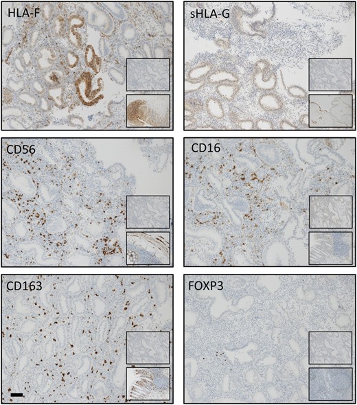 Immunohistochemical staining patterns of HLA-F, sHLA-G, CD56, CD16, CD163 and FOXP3 in the endometrium. The staining was assessed as moderate for all markers. Bar: 100 μm. Upper inserts show negative isotype control staining: HLA-F: rabbit mAb IgG; sHLA-G: mouse mAb IgG1; CD56: rabbit mAb IgG; CD16: mouse mAb IgG2a; CD163: mouse IgG1; and FOXP3: mouse mAb IgG1. Bottom inserts show controls at ×10 magnification: HLA-F: colon; sHLA-G: placenta; CD56, CD16 and CD163: colon; and FOXP3: lymph nodes. (Mean tissue areas analysed were in the range 0.13 mm2 ±0.013 mm2 (HLA-F, glands) to 11.60 mm2 ±8.25 mm2 (FOXP3+) (n = 121)).