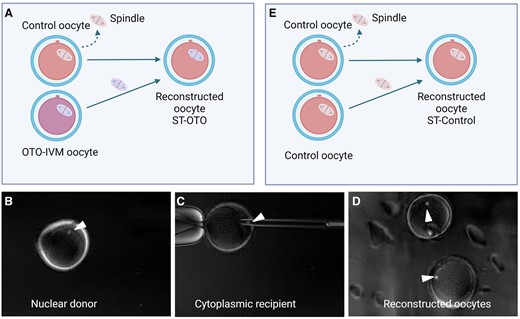 Representation of spindle transfer (ST). (A) ST-OTO group: the spindle of OTO-IVM oocytes from transgender men is transferred into enucleated Control oocytes. (B) Visible spindle of a nuclear donor (OTO-IVM) oocyte right before enucleation. (C) Transfer of an OTO-IVM spindle in an enucleated Control oocyte, serving as the cytoplasmic recipient. (D) Reconstructed oocytes. (E) ST-control group: the spindle of Control oocytes is transferred into enucleated Control oocytes. White arrows in (B), (C), and (D) indicate the visible spindle. OTO-IVM, in vitro matured ovarian tissue oocytes.