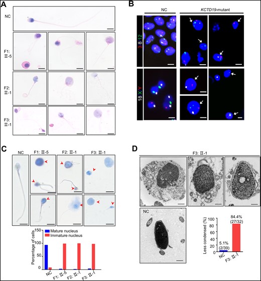 Sperm morphology for the normal control and patients with biallelic KCTD19 variants. (A) H&E staining analysis of spermatozoa from a fertile individual (normal control, NC) and the three probands with biallelic KCTD19 variants. Scale bars = 5 μm. (B) Fluorescence in situ hydriization (FISH) analysis using probe sets for chromosomes 3 (red)/8 (white)/12 (green) and chromosomes 18 (white)/X (green)/Y (red) in spermatozoa from the NC and three probands. Sperm nuclei stained with DAPI (blue). The sperm aneuploidy rates for chromosomes 3/8/12 and chromosomes 18/X/Y are 79.6% ± 7.3% and 76.7% ± 10.5%, respectively, in the probands, compared with 0.15% ± 0.07% and 0.25% ± 0.2%, respectively, in the NC. Representative FISH images of the probands are shown. The white arrows indicate aneuploid sperm. Scale bars = 5 μm. (C) Acidic aniline staining to detect the maturity of epididymal sperm nuclei of the NC and the three probands. Immature nuclei with increased histones are dyed blue or violet (arrowheads, up). The histograms (down) indicate the percentage of the mature and immature nucleus observed in males with biallelic KCTD19 variants. Scale bars = 5 μm. (D) Transmission electron microscopy analysis of spermatozoa from the NC and one proband (F3: II-1) with biallelic KCTD19 variants. The sperm heads from the proband showed abnormal morphology and were frequently embraced by residual cytoplasm containing unassembled flagellar components. Notably, the nuclear chromatin was granular and less condensed. The histograms indicate the percentage of the less condensed chromatin observed in man with biallelic KCTD19 variant. Scale bars = 1 μm.
