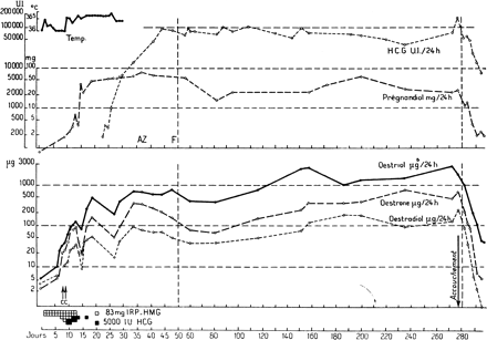 The chart illustrating the first successful induction of ovulation followed by pregnancies in hypogonadotrophic anovulatory women, using a sequential step-up/step-down regime. The starting dose of 240 mg (equivalent to 55 IU) IRP-hMG daily was increased to 360 mg, and then to 480 mg (=110 IU) IRP-hMG, gradually reduced to 360 and finally to 240 mg IRP-hMG daily. Ovulation was induced by administration of 10 000 IU of hCG followed by 10 000 and 5000 IU of hCG on consecutive days.