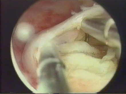 Excision of intramural component by slicing: the electrosurgery is used to slice the neoformation, included into the thickness of the uterine wall (Image kindly donated by I. Ardovino)