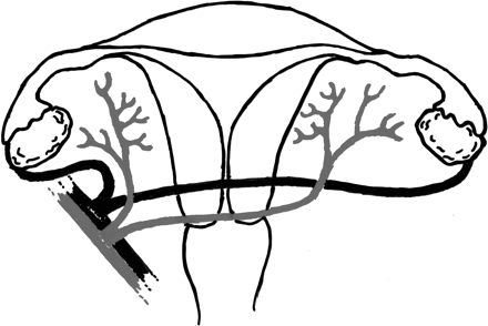 Schematic outline of end-to-side vascular anastomoses of the vessels of a baboon utero-tubal-ovarian graft to the external iliac vessels.