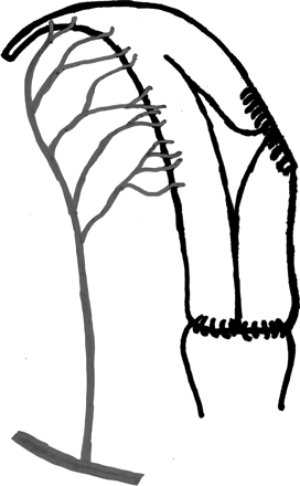 Schematic outline of end-to-side vascular anastomosis between the anterior branch of the left internal iliac artery of a sheep uterine graft and the external iliac vessel.