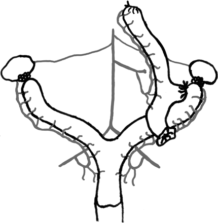 Schematic outline of end-to-side vascular anastomosis between the common iliac artery of a rat uterine transplant and the aorta of the recipient rat. The native uterus is left in situ and the cervix of heterotopically transplanted uterus is connected to a cutaneous stoma.