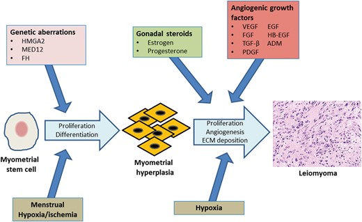 Leiomyoma development. Genetic aberrations involving genes such as HMGA2, MED12 and FH may initiate unregulated cell proliferation of myometrial stem cells. Cyclic menstrual contractions of the myometrium result in periodic hypoxia/ischemia, which may lead to differentiation of myometrial stem cells into SMCs. Continued uncontrolled proliferation of mutated stem cell derived SMCs would result in foci of MMH. The effects of gonadal steroids in combination with the chronic hypoxia associated with the rapidly expanding MMH cell mass would stimulate local angiogenic growth factor expression. These, in turn, would promote continued cell proliferation, and ECM deposition, and provide a vascular support to the growing myometrial cell mass, resulting in leiomyoma formation. SMCs, smooth-muscle cells; HMGA2, high-mobility group AT-hook 2 protein; MED12, mediator subunit complex 12; FH, fumarate hydratase; MMH, myometrial hyperplasia; ECM, extracellular matrix; ADM, adrenomedullin.