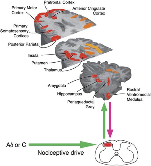 Reprinted from Neuron, Tracey and Mantyh (2007) with permission from Elsevier. Nociceptive input is processed and modulated by ascending and descending pathways in the central nervous system. Many factors influence how the brain processes pain so the pain experience varies both within and between individuals.However, fMRI studies have shown that certain regions are frequently active in response to acute pain. Alterations in activity in some of these regions have been demonstrated in women with CPP (fMRI, functional magnetic resonance imaging).