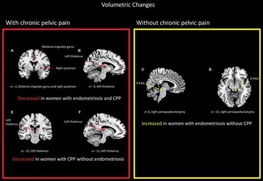 Adapted from As-Sanie et al. (2012) with permission. The figure has been reproduced with permission of the International Association for the Study of Pain® (IASP). The figure may not be reproduced for any other purpose without permission. Regional grey matter changes in women with and without endometriosis and chronic pelvic pain compared with healthy pain-free controls. Red regions represent areas in which grey matter decreased, while yellow regions represent where grey matter increased.