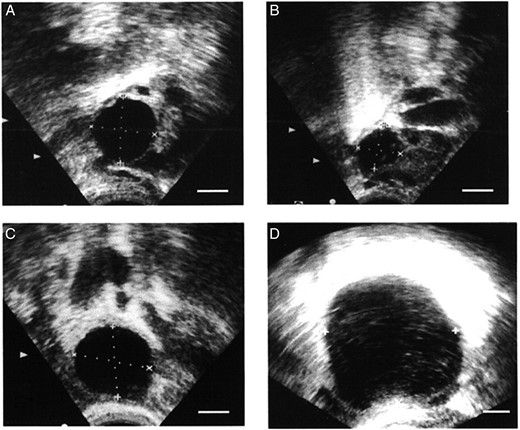 Ultrasound evaluation of ovulatory failure in women. An ovarian follicle in a woman receiving placebo was at 19 mm diameter on the day of the LH peak (A) and showed decreased follicular diameter (follicle collapse; consistent with follicle rupture) on the day after peak LH (B). An ovarian follicle in a woman receiving the PTGS2 inhibitor rofecoxib was at 22 mm diameter on the day of peak LH (C) and was at 50 mm diameter on Day 10 after peak LH (D). With PTGS2 inhibitor treatment, the follicle continued to increase in diameter after the LH surge (no follicle collapse; failure of follicle rupture). In these ultrasound images, ovarian follicles are black circles, with dotted lines to indicate measurement of follicular diameters. All panels are at approximately the same magnification. Republished with permissions from Pall et al. (2001).