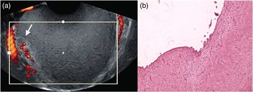 Ultrasonographic (a) and histologic (b, low-power magnification) patterns of a decidualized endometrioma (reproduced with permission from Mascilini et al., 2014 and Barbieri et al., 2009).