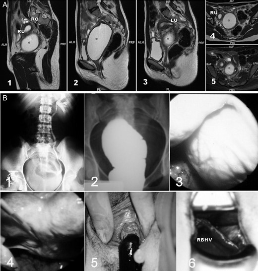 Unilateral renal agenesis and ipsilateral obstructed hemivagina with haematocolpos. (A) Magnetic resonance imaging (MR) of a 16-year-old patient with a unilateral blind hemivagina and ipsilateral renal agenesis who experienced strong dysmenorrhea. After clinical examination and MR, she was diagnosed with endometrioma in another hospital. However, a didelphys uterus and right haematocolpos (*) can be observed; 1–3, sagittal cuts from right to left; 4–5, axial cuts from caudal to cranial. RO, right ovary; RU, right hemiuterus; LU, left hemiuterus. ALH/ALF, anterior; PRF/PRH, posterior; HR, head; FL, foot; RAF, right; LPH, left. (B) Images from a 17-year-old patient with unilateral renal agenesis and ipsilateral blind hemivagina syndrome who presented with a large haematocolpos. 1, i.v. pyelogram showing the right renal agenesis; 2, colpography of the right blind hemivagina filled with contrast agent. The transvaginal puncture allows the chocolate-coloured blood to drain, and the injection of a contrast agent permits the visualization of the blind vagina and fills the corresponding hemiuterus and tube in a retrograde manner, revealing potential inter-uterine communication at the level of the isthmus; 3, laparoscopic observation of an intraperitoneal bulging haematocolpos; 4, laparoscopic observation of the bicornuate uterus after drainage of the haematocolpos; 5, drainage of the haematocolpos; 6, observation of both hemivaginas and the vaginal septum. RBHV, right blind hemivagina.