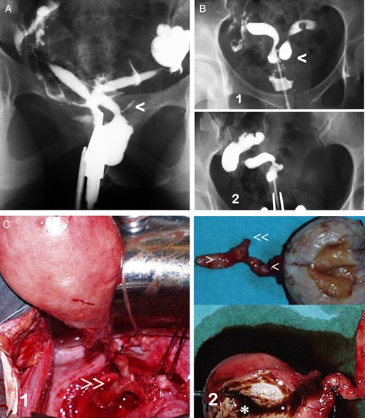 Unilateral renal agenesis and ipsilateral cervicovaginal atresia with or without communicating uteri. (A) HSG image in a case with a mesonephric anomaly involving an apparent bicornuate-unicollis uterus in which the atretic left hemi-cervix is permeable, fistulous and communicating with an atretic left blind hemivagina. There was also left renal agenesis. This presentation corresponds to Herlyn–Werner syndrome (Herlyn and Werner, 1971). Moreover, a remnant of the mesonephric duct or ectopic ureter can be observed (<). (B) Images of a patient with primary infertility who was diagnosed with a genitourinary malformation (left cervicovaginal atresia and renal agenesis with communicating bicornuate uterus) and endometriosis. She underwent surgery in another hospital, where they performed a left hemi-hysterectomy, and an endometrioma in the left ovary was removed. 1, HSG image before surgery; 2, current HSG image. (modified with permission from Acién et al., 2004c); (C) images of a patient with unilateral cervicovaginal atresia and no communication between the two hemi-uteri. There was also right renal agenesis. After a right adnexectomy to treat tubo-ovarian and appendicular endometriosis was performed in another hospital, a large unilateral right haematometra developed, with severe clinical symptoms. 1, during the right hemi-hysterectomy, we identified what we thought was the mesonephric duct (>>); 2, surgical image showing the cervical and vaginal atresia (> and <) and the mesonephric remnant (<<) (modified with permission from Acién et al., 2004a).
