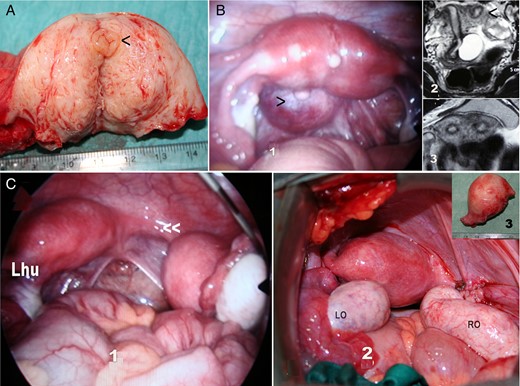 Cases with a cavitated and non-communicating uterine horn. (A) Surgical image of hemi-hysterectomy showing an endometrial cavity (<); (B) another case with a cavitated and non-communicating uterine horn: 1, laparoscopic image of an apparently normal or very slightly arcuate uterus with normal adnexa, and a left retrocervical subperitoneal serous cyst (>) corresponding to a Müllerian remnant. 2 and 3, MR of the same case showing the left cavitated and non-communicating rudimentary uterine horn (<). Due to the absence of symptoms, only the cyst was excised. (C) Case with a left unicornuate uterus and proximal segmentary atresia of the right horn. 1, Laparoscopic image showing the right atretic uterine segment (<<) with a normal and cavitated distal uterine segment and normal right adnexa; 2, a right hemi-hysterectomy was performed and the rudimentary horn with haematometra is shown in 3.