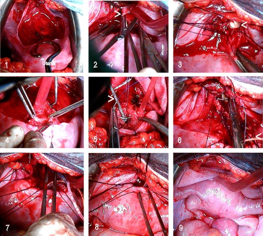 Sequence of utero-neovaginal anastomosis in a 21-year-old patient with primary amenorrhoea and cyclic pelvic pain since 16 years of age. Following a diagnosis of complete cervicovaginal atresia with normal corpus uteri and ovaries, she underwent a McIndoe neovagina procedure; after 3–4 months, we performed a laparotomy with utero-neovaginal anastomosis. 1, Bladder dissection; 2, neovaginal fundus opening (>); 3, fixing sutures to open the neovagina. Note the prosthesis in the vagina (<). 4, removal of the atretic cervical portion and resection of the inferior portion of the uterine corpus; 5, hysterometre (>) inserted in the uterus and the beginning of stitches in the myometrium (uterus flipped back); 6, suturing of the corpus uteri to the neovagina; Foley catheter in the uterus (<); 7, Foley catheter introduced into the endometrial cavity and extracted via the vagina; 8, anterior suture of the corpus uteri to the neovagina; 9, final result.