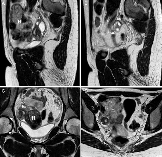 MR images corresponding to a 17-year-old patient with Rokitansky syndrome. She had a right cavitated rudimentary uterine horn with retrograde menstruation and pelvic haematomas (H). (A, B) Saggital cuts; (C, D) axial cuts. U, uterus, cavitated horn. RO, right ovary. LO, left ovary.