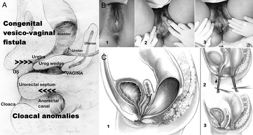 Urogenital sinus and cloacal anomalies. (A) Embryological drawing (sagittal section) of female genitalia at 12–13 weeks gestation illustrating the developing vagina, urethra, cloaca and urogenital sinus as well as the urorectal septum, which separates the cloaca and sinus, and the urogenital wedge, which separates the ureter-urethra and vagina. The allocation of the urogenital sinus and cloacal anomalies is indicated. (B) Images of an imperforate hymen. 1, Imperforate hymen in a 13-year-old girl showing a bulging hymen due to haematocolpos; 2 and 3, another patient with an imperforate hymen; the drainage of the haematocolpos in shown in 3; (C) cloacal malformations; 1, cloaca with a short common channel; 2 and 3, surgical correction following the Peña technique based on total urogenital mobilization (reprinted with permission from Levitt and Peña, 2010).