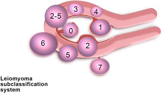 FIGO classification of uterine fibroids according to Munro et al. (2011). Fibroid types range from 0 to 8. 0 = Pedunculated, intracavitary; 1 = Submucosal, <50% intramural; 2 = Submucosal, ≥50% intramural; 3 = Contact with endometrium, 100% intramural; 4 = Intramural; 5 = Subserosal, ≥50% intramural; 6 = Subserosal, <50% intramural; 7 = Subserosal, pedunculated; 8 = Other (e.g. cervical, parasitic). Where two numbers are given (e.g. 2–5), the first number refers to the relationship with the endometrium, while the second number refers to the relationship with the serosa; e.g. 2–5 = Submucosal and subserosal, each with less than half the diameter in the endometrial and peritoneal cavities respectively. Fibroid classification cartoon republished with permission from Munro et al. (2011).