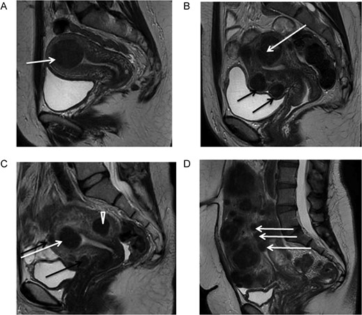 Magnetic resonance imaging (MRI) of fibroids. Midline sagittal T2-weighted images show different types of myomas according to the FIGO classification (Munro et al., 2011). Fibroids vary in size, number and site in the uterus. (A) Submucosal type 2 myoma. (B) Large type 2–5 myoma (white arrow): submucosal and subserosal, each with less than half the diameter in the endometrial and peritoneal cavities respectively. Subserosal type 5 myomas (subserosal, >50% intramural) (black arrows). (C) Submucosal type 2 myoma (>50% intramural) (white arrow). Intramural type 4 myoma (arrowhead). Small type 5 myomas (black arrows). (D) Multiple myomas, three of which are type 0 (intracavitary) (white arrows).