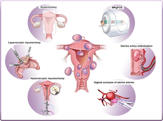 Current surgical and non-surgical management strategies of myomas. Left panel: hysterectomy, laparoscopic myomectomy and hysteroscopic myomectomy are the most widely used surgical interventions for myomas. Right panel: alternatives to surgical intervention include uterine artery embolization (UAE), high-frequency magnetic resonance-guided focused ultrasound surgery (MRgFUS) and vaginal occlusion of uterine arteries.