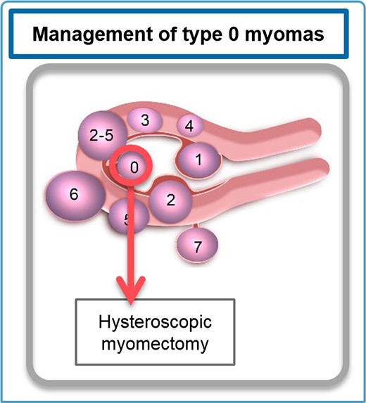 Management of type 0 myomas. Hysteroscopic myomectomy is the most appropriate approach. Fibroid classification cartoon republished with permission from Munro et al. (2011).