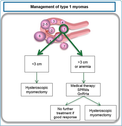 Management of type 1 myomas. Depending on the myoma size, presence of anemia and the surgeon's skill, hysteroscopic myomectomy combined or not with ulipristal acetate(UPA) should be proposed. Fibroid classification cartoon republished with permission from Munro et al.(2011).