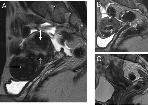 Considerable shrinkage of all myomas after four courses of intermittent ulipristal acetate (UPA) therapy. A patient aged 30 years presented with heavy menstrual bleedingand an unclear desire for pregnancy. (A) Before treatment, a midline sagittal T2-weighted magnetic resonance image (MRI) demonstrated the presence of multiple myomas: type 2, 3, 4 and 6. (B) Upon completion of treatment (intermittent UPA therapy (four courses of threemonths), the uterine cavity was no longer distorted. (C) One year after delivery of a healthy baby, no fibroid regrowth was observed after delivery.