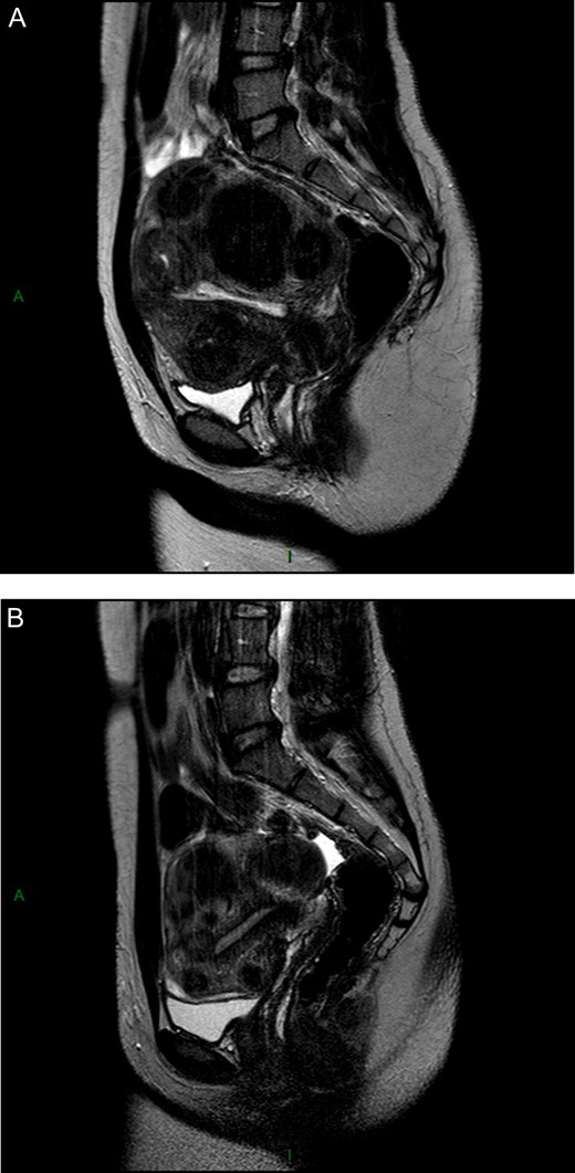 Important shrinkage of the submucosal myoma was obtained after two courses of three months of intermittent ulipristal acetate (UPA) therapy. (A) Coronal T2-weighted magnetic resonance image (MRI) image illustrated the presence of multiple myomas (type 2, type 2-5) distorting the uterine cavity in a 19-year-old nulligravid patient, who presented to the emergency department, with heavy menstrual bleeding and anaemia (haemoglobin level of 7.4 g/l).The patient received two courses of UPA (5 mg) and iron. (B) At the end of therapy, MRI demonstrated a significant reduction in myoma volume (<50%) and restoration of the uterine cavity. Amenorrhea was achieved, with a haemoglobin level of 11.9 g/l. The patient was free of symptoms and did not wish to conceive; therefore, surgery was avoided.