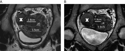 27 year-old women complaining of heavy menstrual bleeding and pelvic pain. A: Coronal T2-weighted MRI images illustrated the presence of type 2–5 and type 3 myomas distorting the uterine cavity and an endometrioma (indicated by X) of 4.3 cm in size. The white lines represent the diameter of the myomas. This patient received long-term intermittent therapy with 5 mg of UPA (2 courses of 3 months). B: At the end of therapy there was an important reduction in myoma volume, but not endometrioma volume.