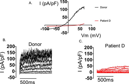 Electrophysiological recordings from sperm from a donor and patient D (lacking IKSper). Consecutive electrophysiological recordings of a spermatozoon from a donor and patient D to ramp (−92 to 68mV, A) and stepped (−52 to 68 mV, B and C) depolarization under quasi-physiological ion conditions (see Brown et al., 2016). Both depolarization protocols induce a robust outward current in the donor cell. In contrast, only under extreme depolarization (>98 mV) is outward current seen in the cell from patient D (C).