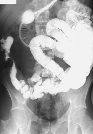 SBE. Crohn's ileitis: the inflammatory involvement of the terminal ileum with a stricturing complication of disease is evident.